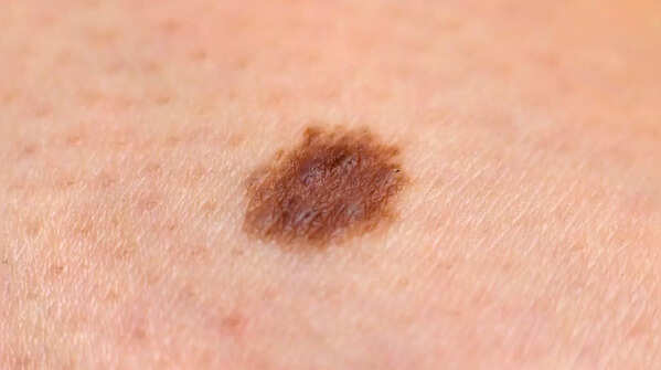 Pigment spreading around a mole, an alarming sign of skin cancer