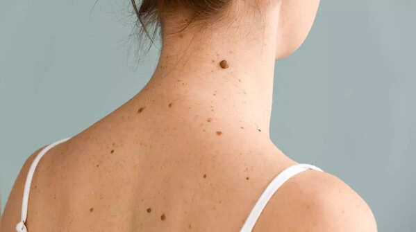 A new growth on the skin, check for possible skin cancer