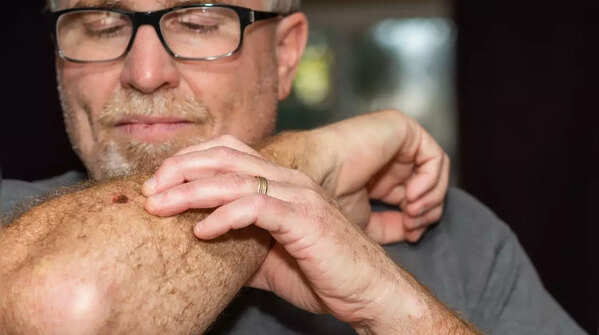 Close-up of skin, showing the importance of early detection