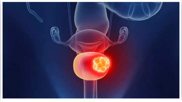 Woman experiencing lower back and pelvic pain, pointing out a potential symptom of advanced bladder cancer