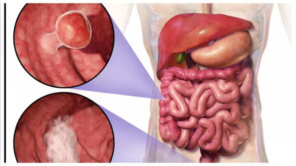 Depiction of blood in stool as a sign of colon cancer.